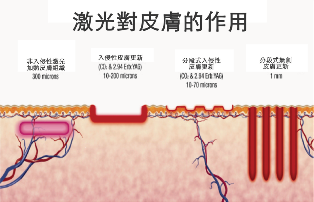 激光對皮膚的作用