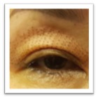 upper eyelid