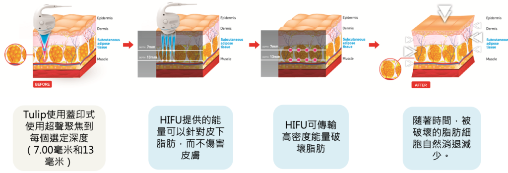 Hifu17