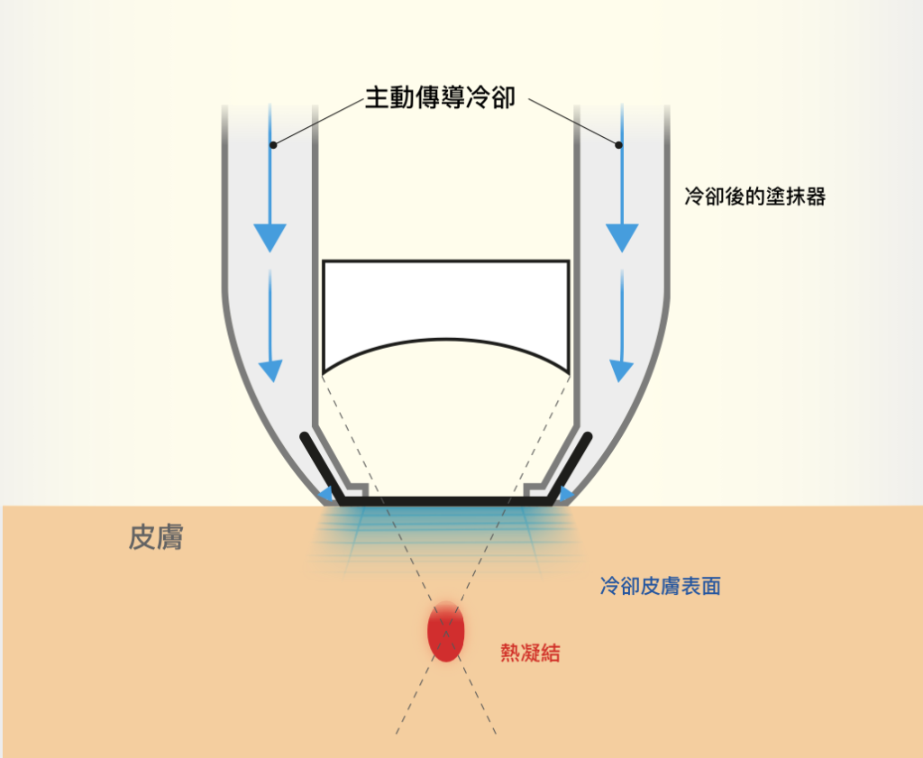 liftera cool冰感無針埋線冷凍原理